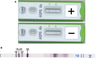 Multicenter Evaluation of a Novel Immunochromatographic Test for Anti-aspergillus IgG Detection